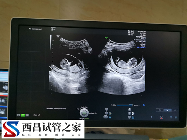不是每个人都适合怀双胞胎
